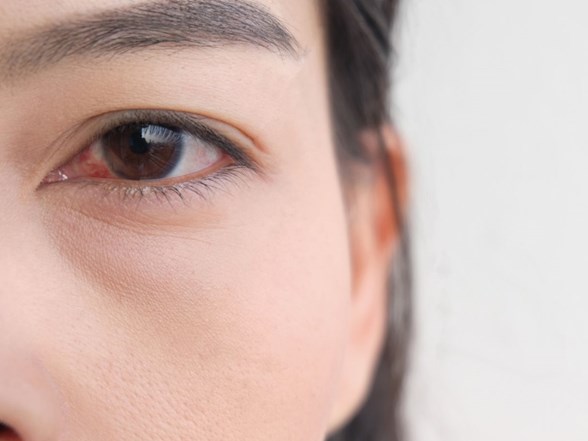 kirmizi goz corona virus belirtisi olabilir saglik haberleri ntv