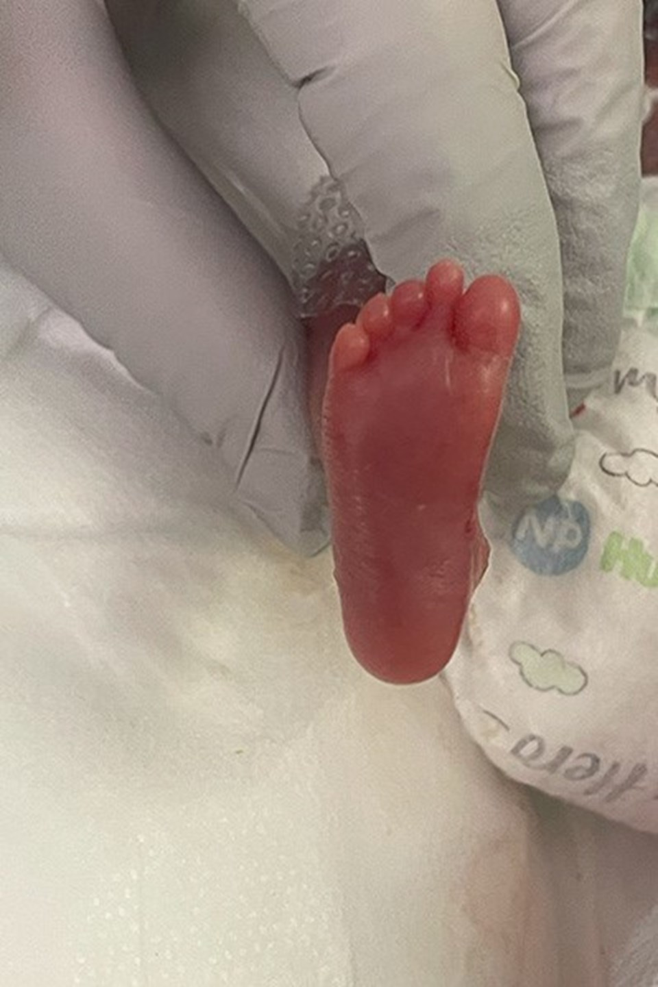 Dünyanın en prematüre bebeği: 280 gram doğdu, doktorlar yaşamaz dedi - 1