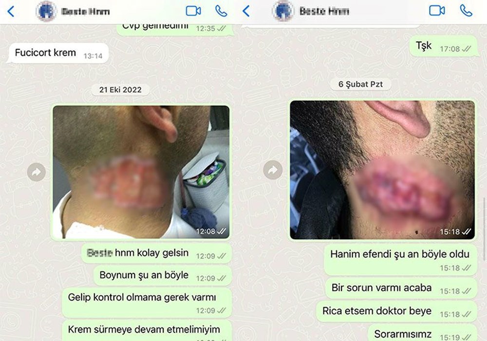 Lazer hayatını kararttı: Tedavi 30 yıl geriye götürdü - 3