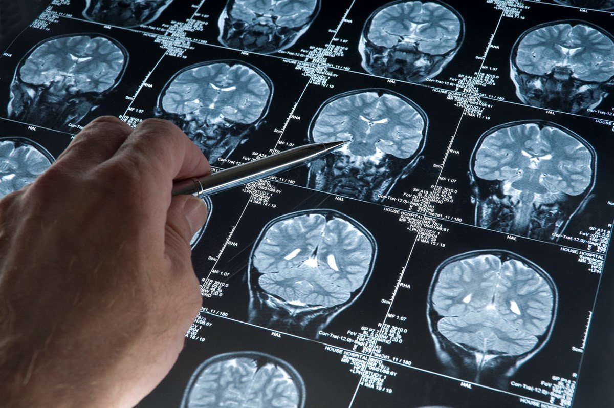 Her yıl 21 Eylül “Dünya Alzheimer Günü” olarak kutlanıyor.