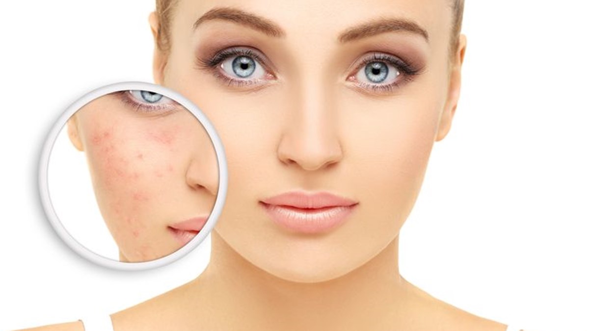 yuzu kizartan neden rozasea gul