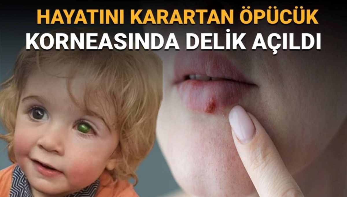 2 yaşındaki bir çocuk öpücük yüzünden kör oldu: Herpes Simpleks Virüsü (HSV) nedir, belirtileri neler?