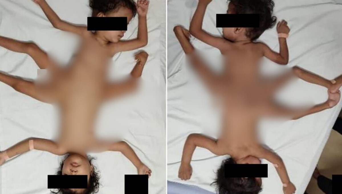 Dünya şaşkına döndü : 2 milyonda bir görülen Dünya şaşkına döndü : 2 milyonda bir görülen