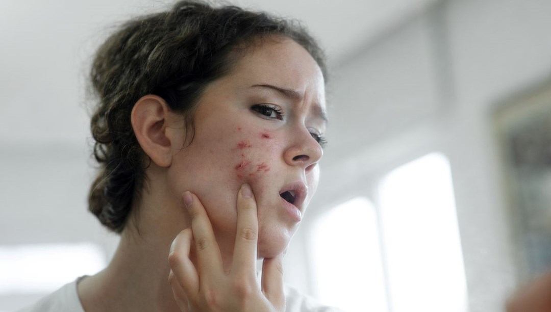 Karaciğer kanseri işareti olabilir: Uzmanı ciltte ortaya çıkan belirtilerini açıkladı