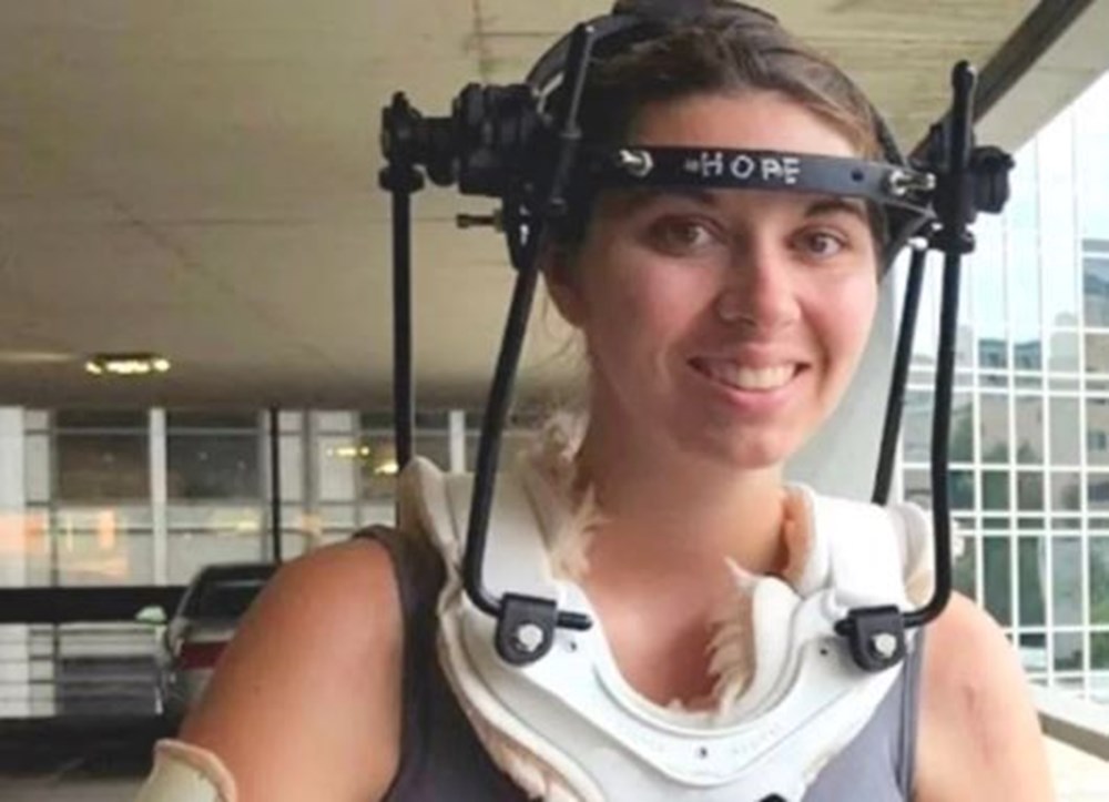 Kafatası omurgasından ayrılmak üzereydi: 37 ameliyat geçirdi 72 elRGG5owiUWy0XJEvip bQ