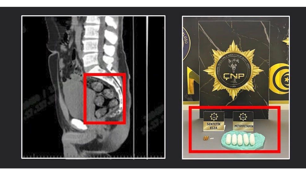 Tomografide şok eden görüntü: Midesinden çıkarıldı