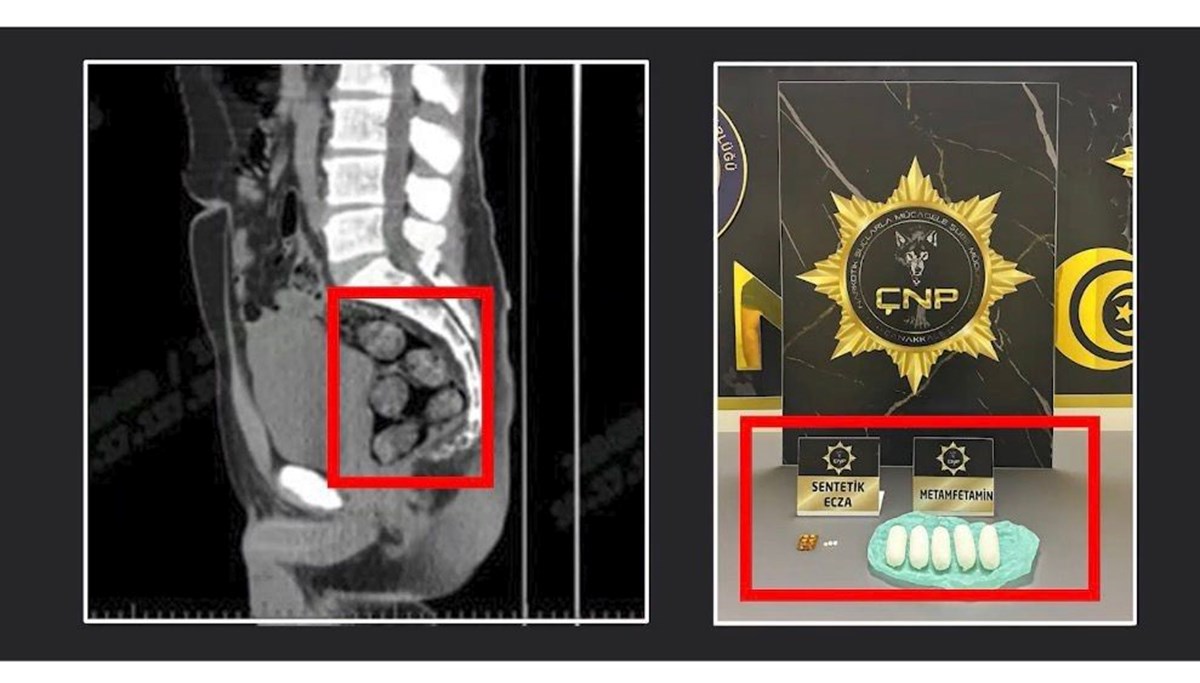 Tomografide şok eden görüntü: Midesinden çıkarıldı Tomografide şok eden görüntü: Midesinden çıkarıldı
