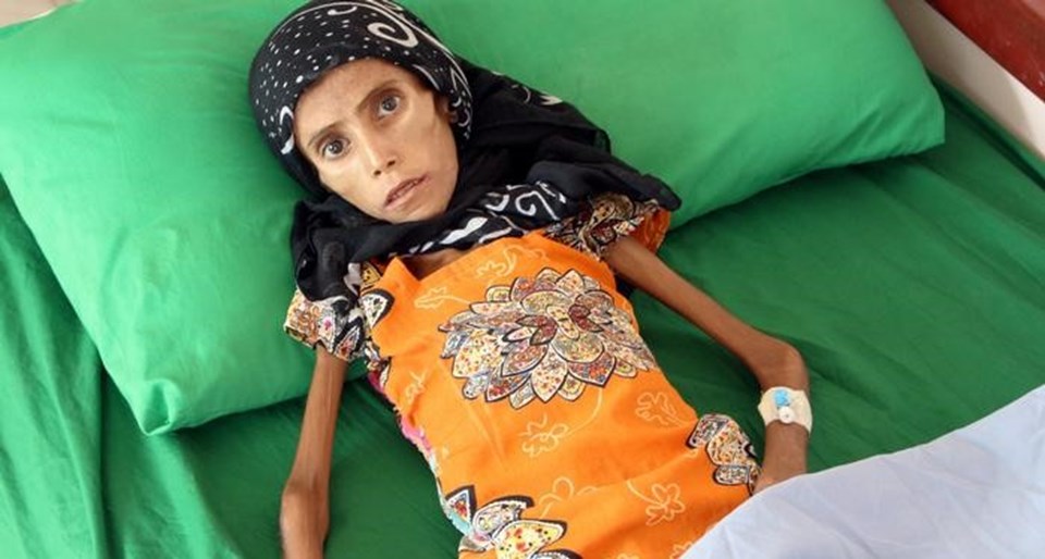 10 kg ağırlığındaki Yemenli kız tedavi altına alındı - 1
