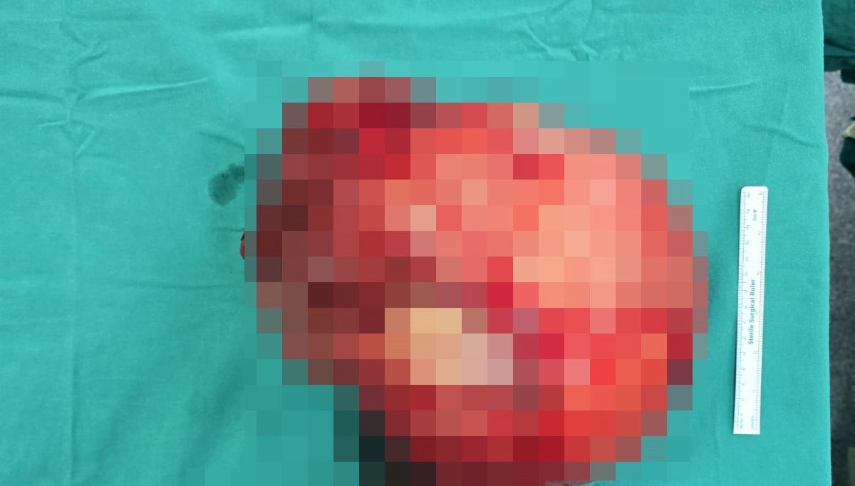 Karın ağrısı şikayetiyle doktora giden kadının karnından çıktı: 6 kilogram ağırlığında