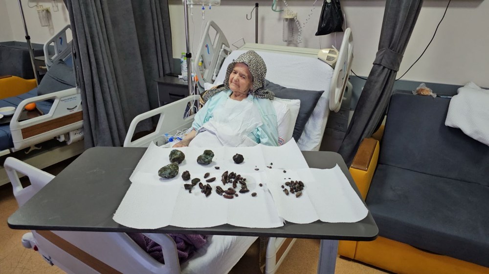 92 yaşındaki kadının midesinden ve bağırsaklarından çıktı: Kaç senedir yiyordum, zarar vereceğini düşünmedim - 5