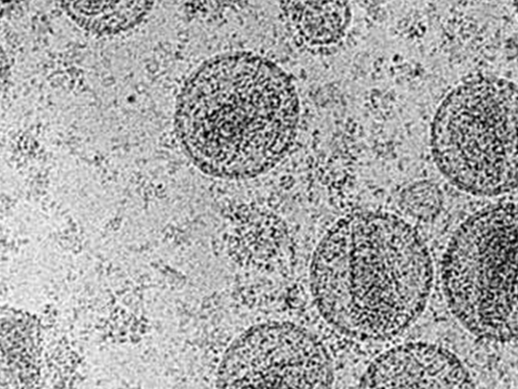 hiv 3 ile 15 yil icinde aids olabilir