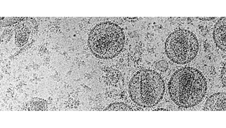 hiv 3 ile 15 yil icinde aids olabilir