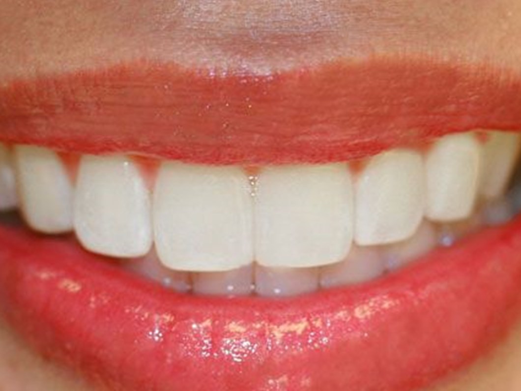 dis eti problemleri kemik erimesine