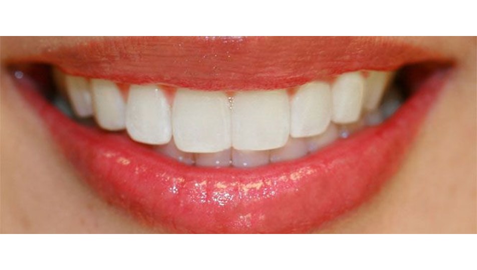 dis eti problemleri kemik erimesine