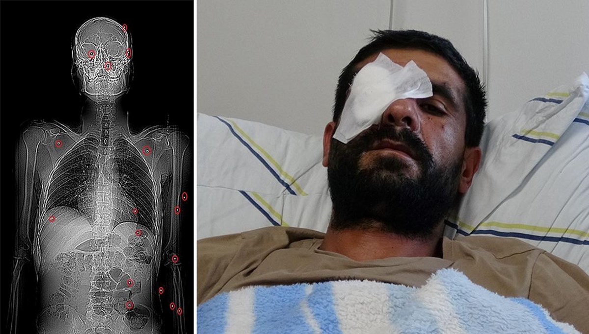 Hasımları pusu kurdu, bir gözünü kaybetti (Vücudunda 32 saçmayla yaşıyor) Hasımları pusu kurdu, bir gözünü kaybetti (Vücudunda 32 saçmayla yaşıyor)