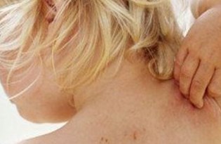 izmir de uyuz vakalariyla birlikte uyuz