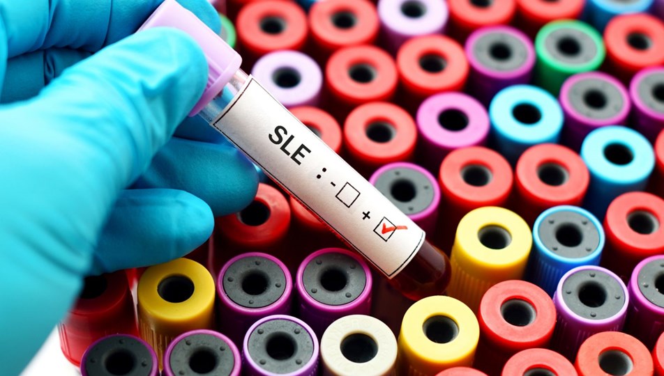 Kelebek hastalığı (lupus) neden olur, belirtileri nelerdir? Kelebek hastalığı nasıl tedavi edilir?
