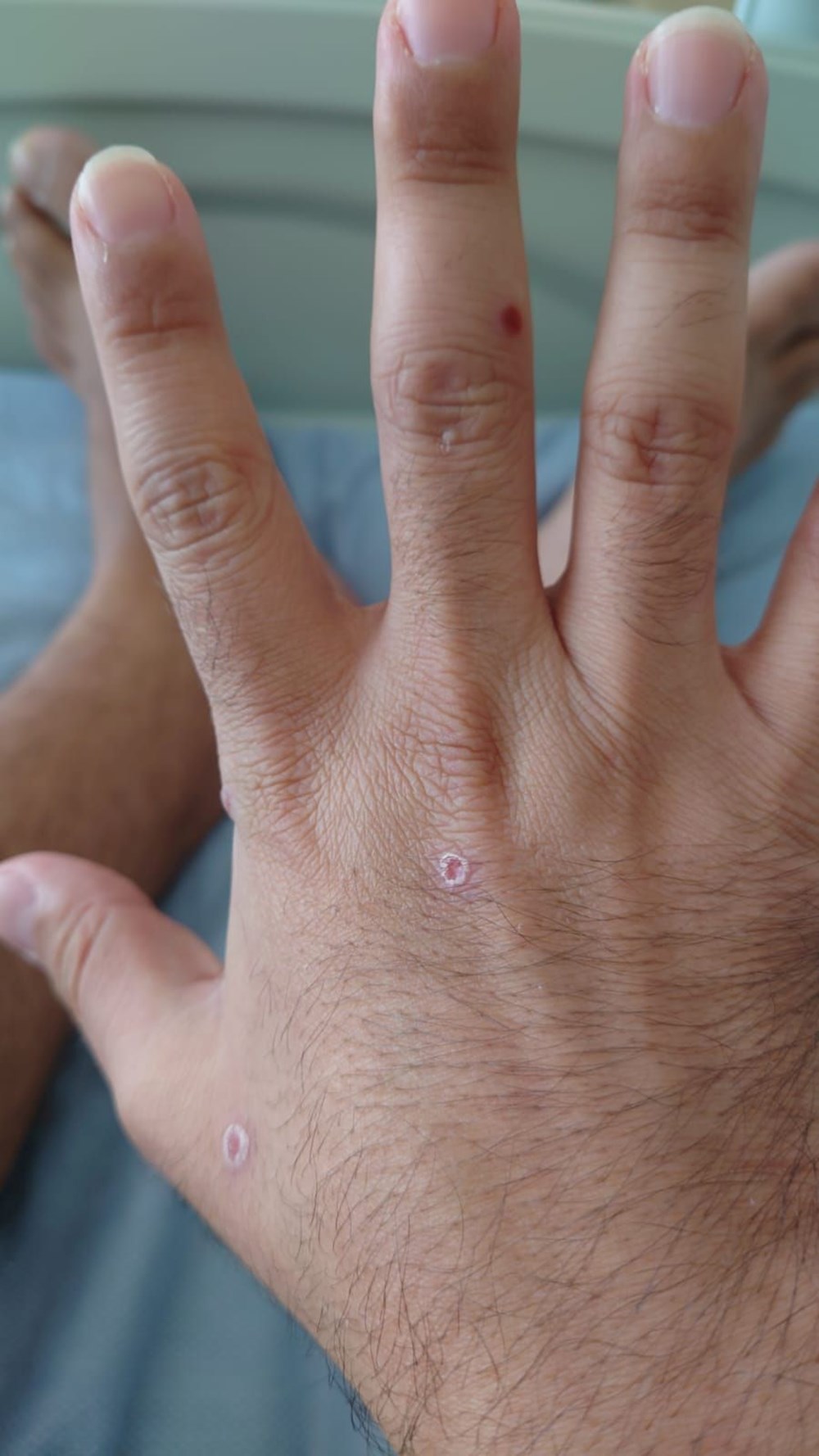 Dünyanın konuştuğu hasta: Önce HIV ve Covid sonra da maymun çiçeği - 13