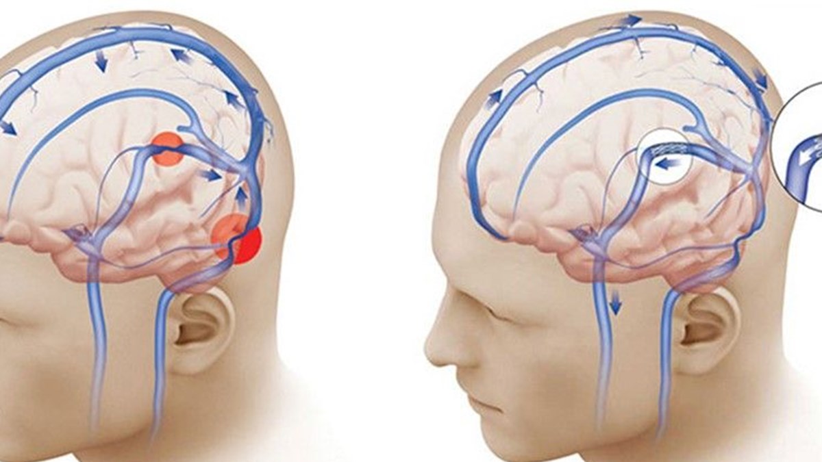 bas agrisinin nedeni yalanci tumor