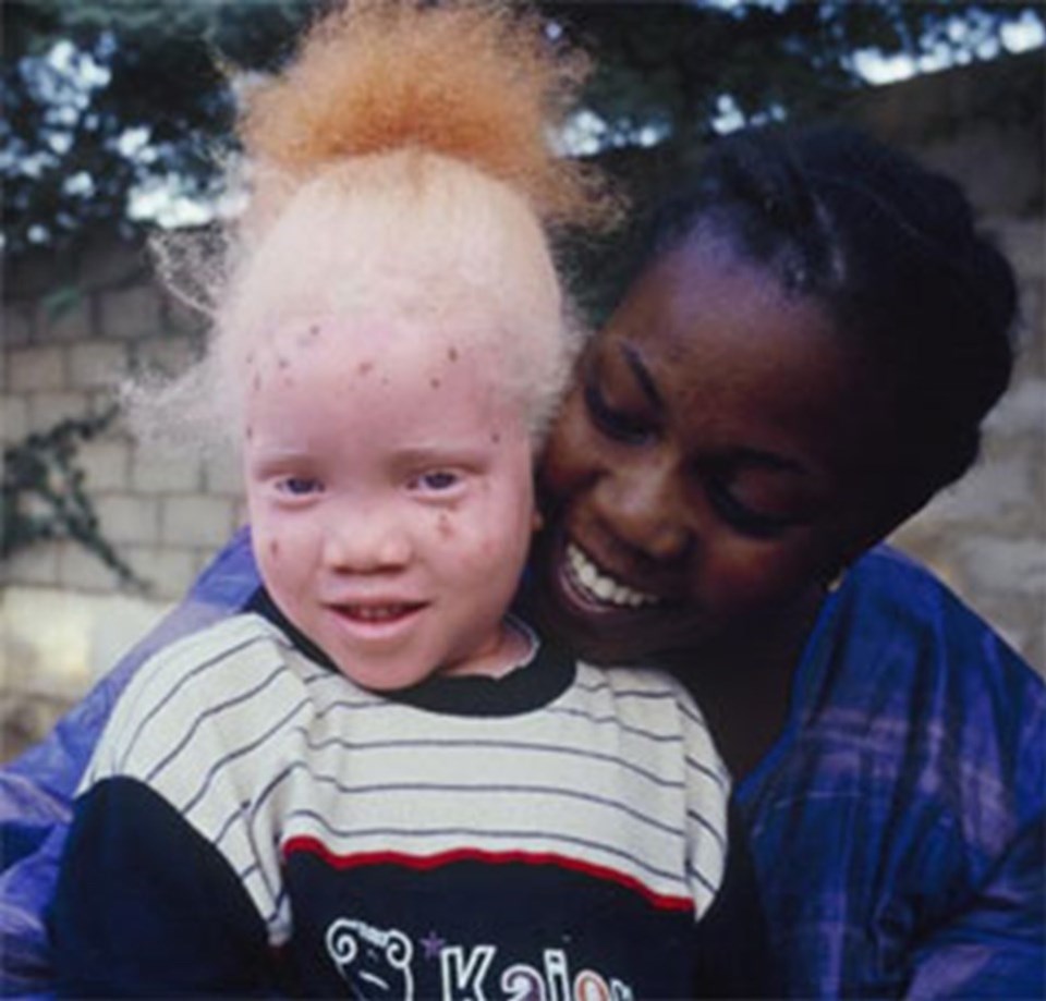 Afrika'nın talihsiz beyazları: Albinolar - 1