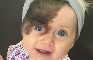 dogum lekelerine dikkat dogum lekesi