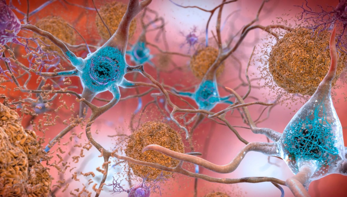 Alzheimer tedavisinde yeni umut