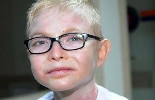 lupus neden olur belirtileri nelerdir