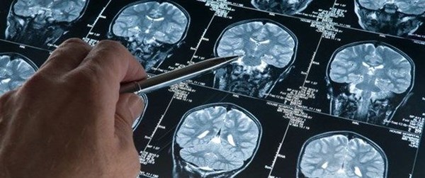 Alzheimer beyne 25 yıl öncesinde yerleşiyor