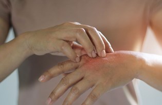 izmir de uyuz vakalariyla birlikte uyuz