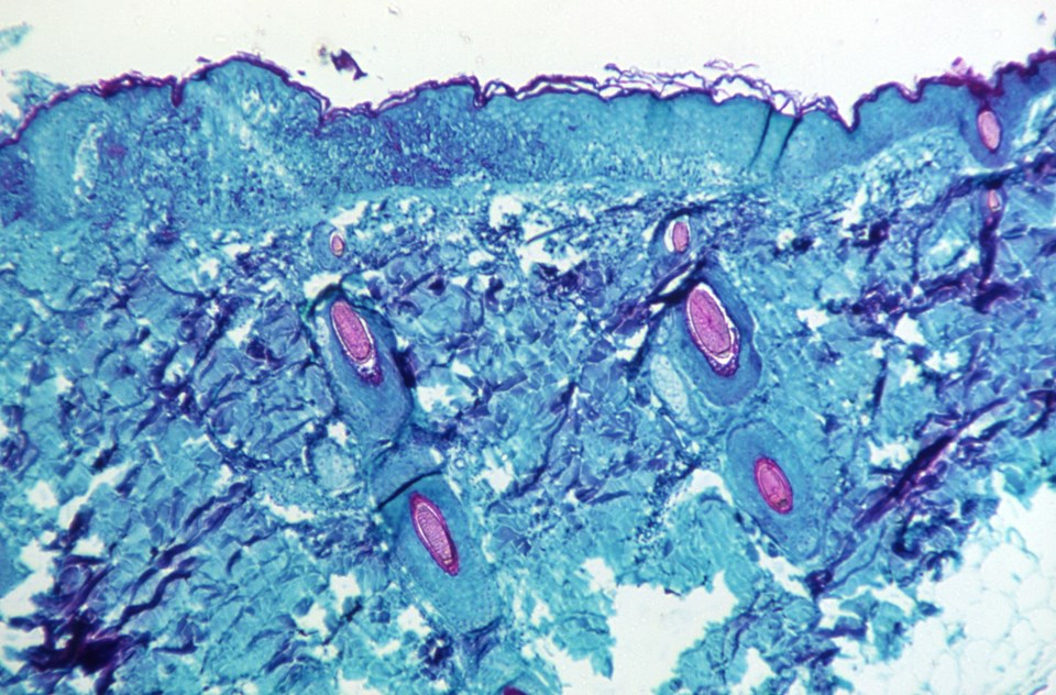 Maymun Çiçeği virüsü nedir, nasıl bulaşır? Maymun Çiçeği (Monkeypox) virüsünün belirtileri nelerdir, ölümcül mü, tedavisi var mı? - 1