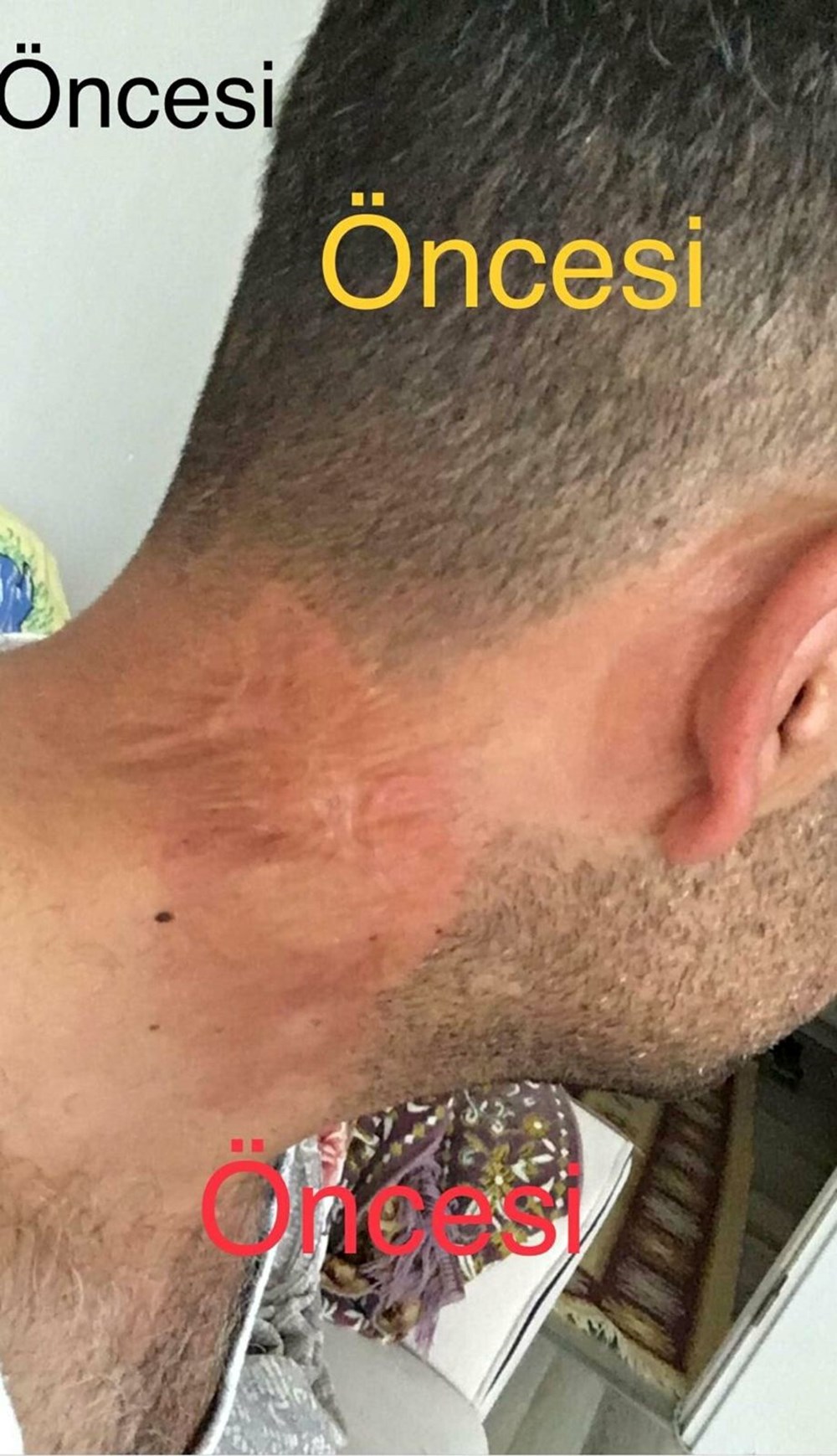 Lazer hayatını kararttı: Tedavi 30 yıl geriye götürdü - 4