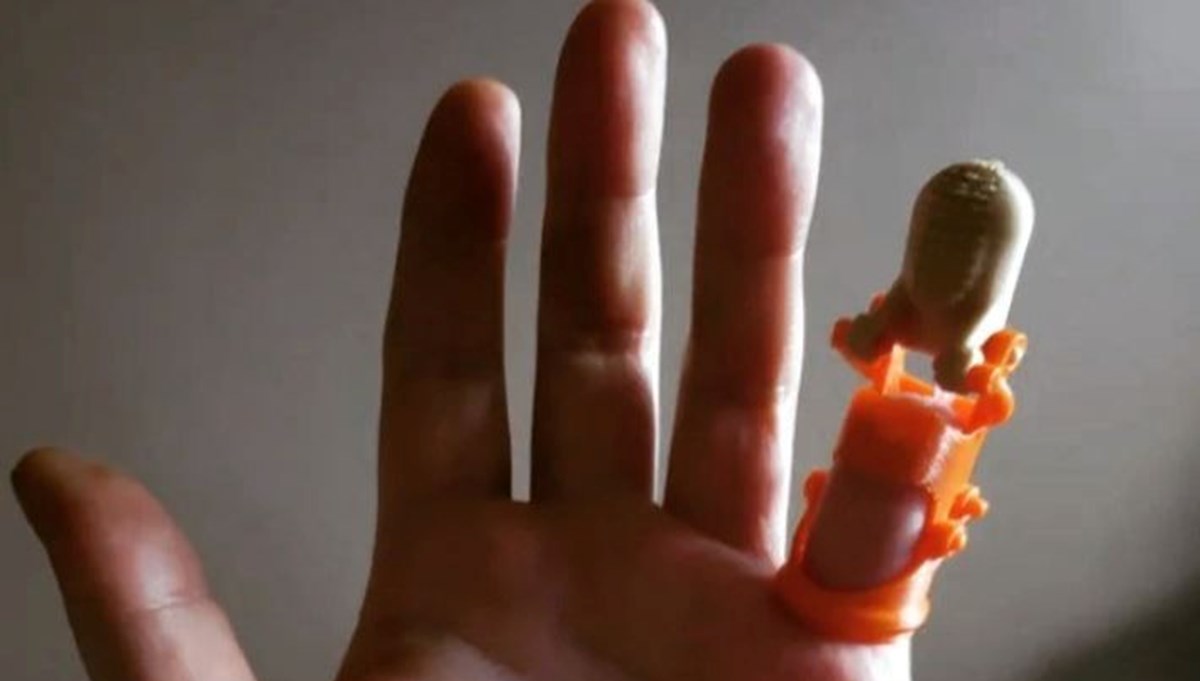 Kopan parmağına 20 yıl sonra 3 boyutlu yazıcıyla kavuştu