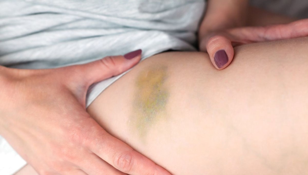 Vücudundaki morlukları önemsemedi: Meğer kanserin ilk belirtisiymiş Vücudundaki morlukları önemsemedi: Meğer kanserin ilk belirtisiymiş