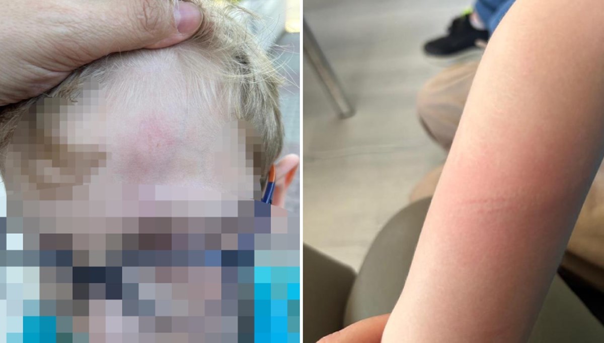 Beylikdüzü’nde okulda demir çubuklu dayak iddiası: Kafası şişti, kollarında kızarıklıklar oluştu Beylikdüzü’nde okulda demir çubuklu dayak iddiası: Kafası şişti, kollarında kızarıklıklar oluştu