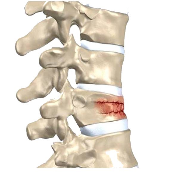 Omurga Cokme Kirigi Kabusunuz Olmasin Saglik Haberleri Ntv Omurga Cokme Kirigi Kabusunuz Olmasin Saglik Haberleri Ntv