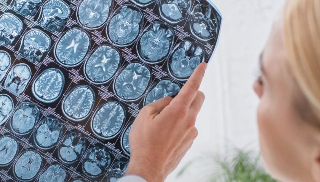 13 haftada 9 ameliyat geçirdi: Kafatasını midesinde taşıdı