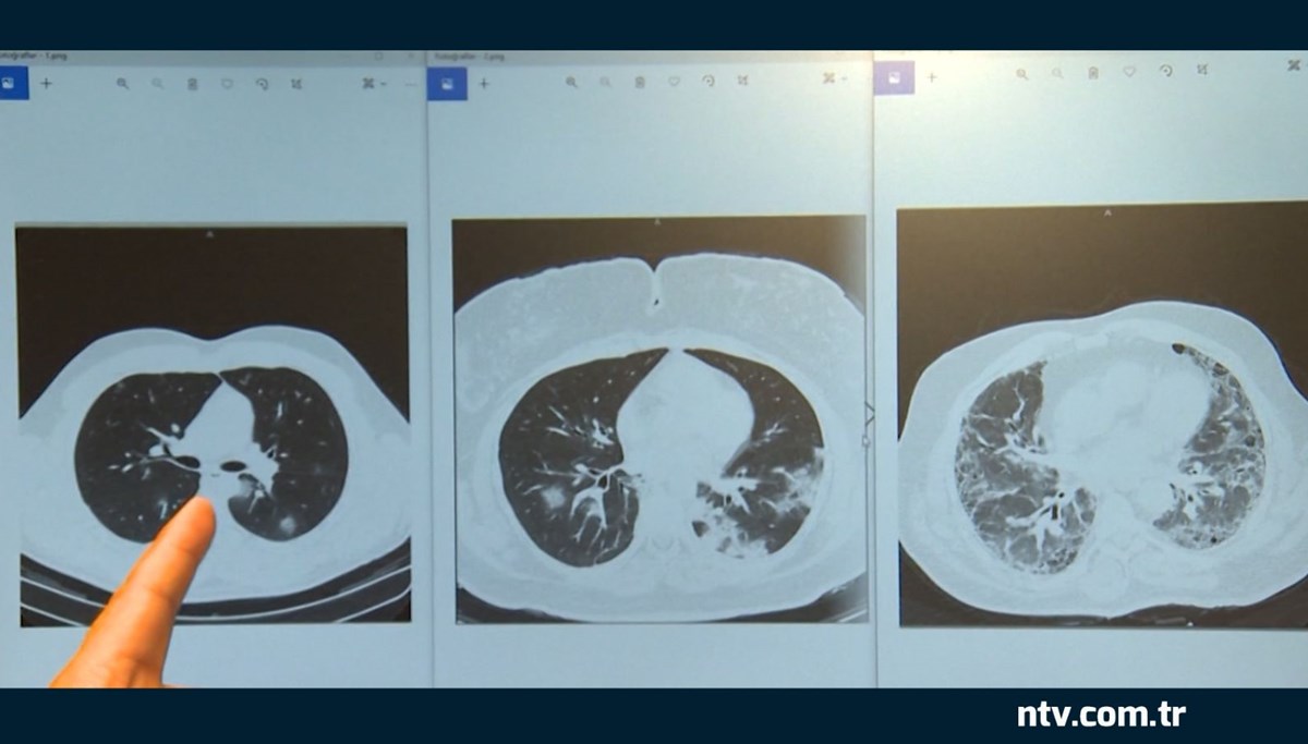 Aşılı-aşısız farkı röntgen filminde: İşte üç Covid hastasının akciğerleri