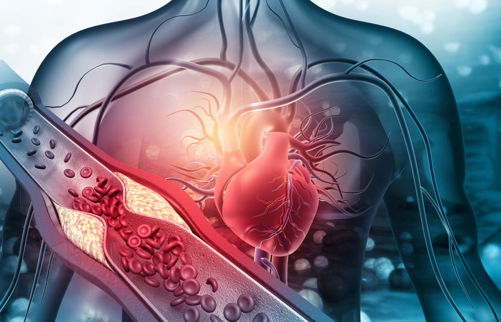 Het wordt genegeerd, maar het is een teken van een hoog cholesterol: de meeste mensen hebben dit symptoom - 5