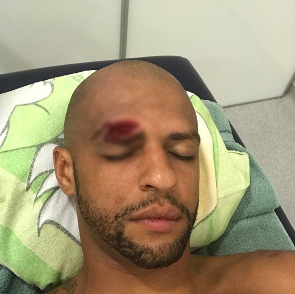 Felipe Melo'nun kaşı açıldı - 1