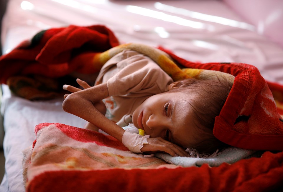UNICEF: Yemen'de her 10 dakikada bir çocuk yetersiz beslenme ve önlenebilir hastalıklar yüzünden ölüyor - 1