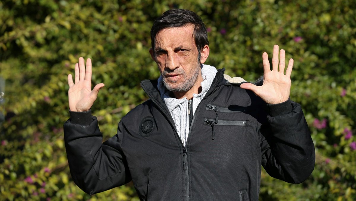 Türkiye'nin ilk yüz nakli: Üzerinden 10 yıl geçti