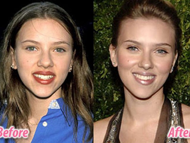 unlulerin estetik oncesi ve sonrasi magazin haberleri ntv