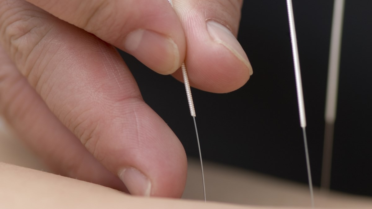 Devlet Hastanesinde Akupunktur Tedavisi Basladi Saglik Haberleri Ntv