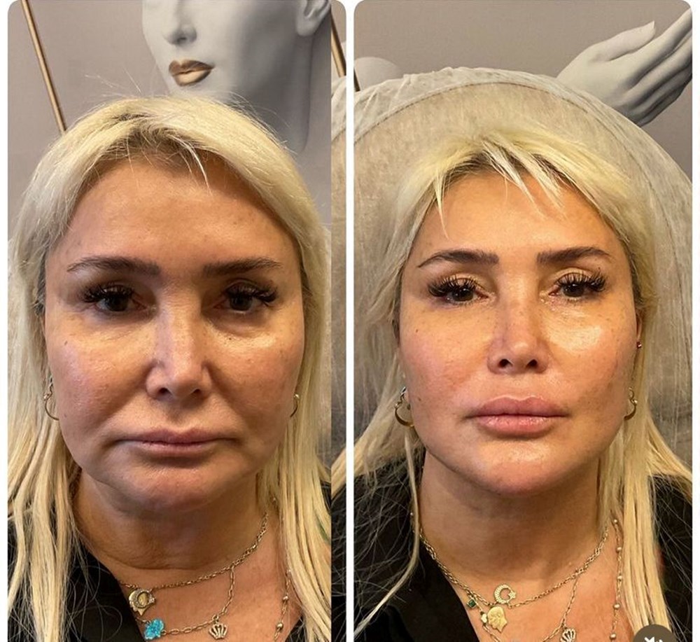 Yonca Evcimik estetik