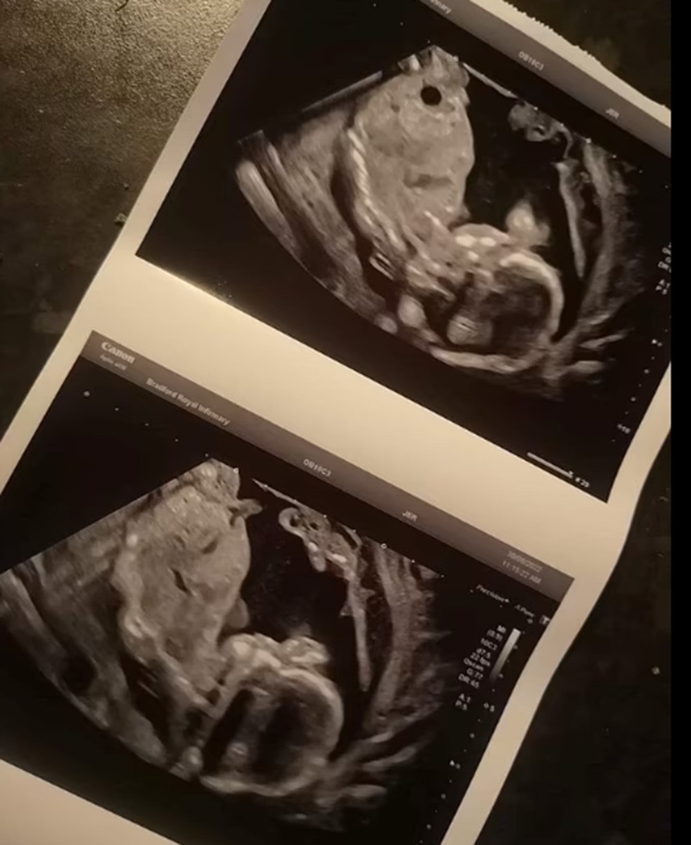 Annelik içgüdüsü kurtardı: Doktorların 'ölü' dediği bebeği canlı doğurdu - 5