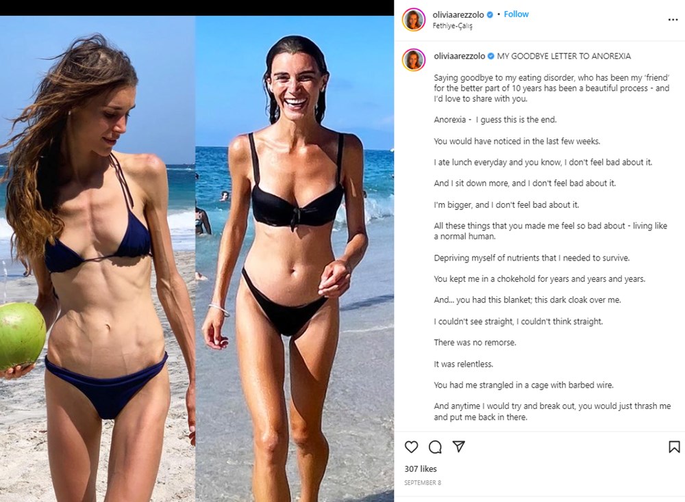 Yeme bozukluğu yaşayan Olivia Arezzolo'nun hayatı bir fotoğrafla değişti - 5