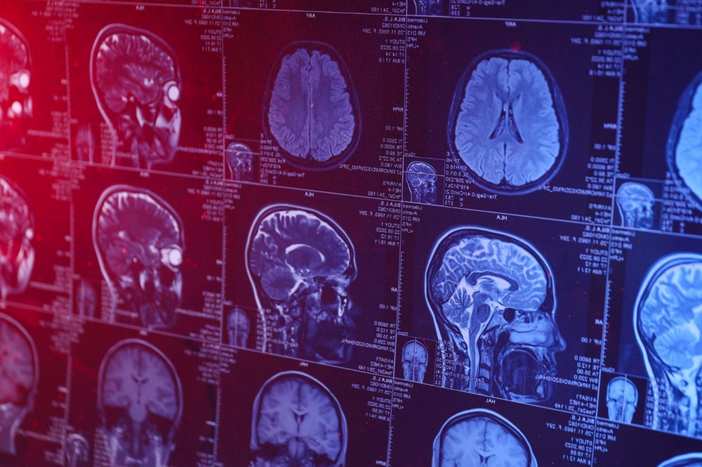 Alzheimer vakaları neden arttı? - 6
