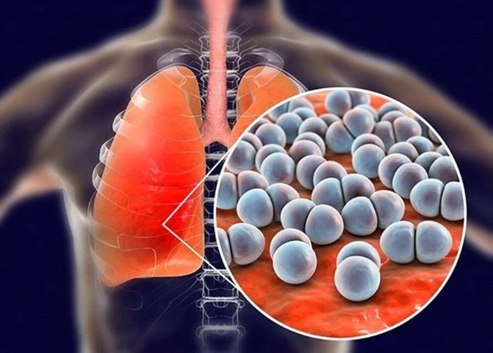 Halk arasında "beta" olarak bilinen bakteri neden oluyor: Strep A nedir, belirtileri neler? - 1