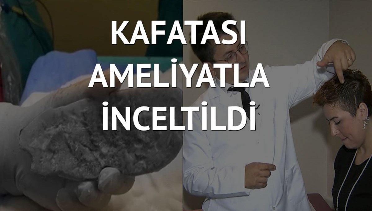 Geçmeyen baş ağrılarının nedeni kafatası kalınlaşması çıktı