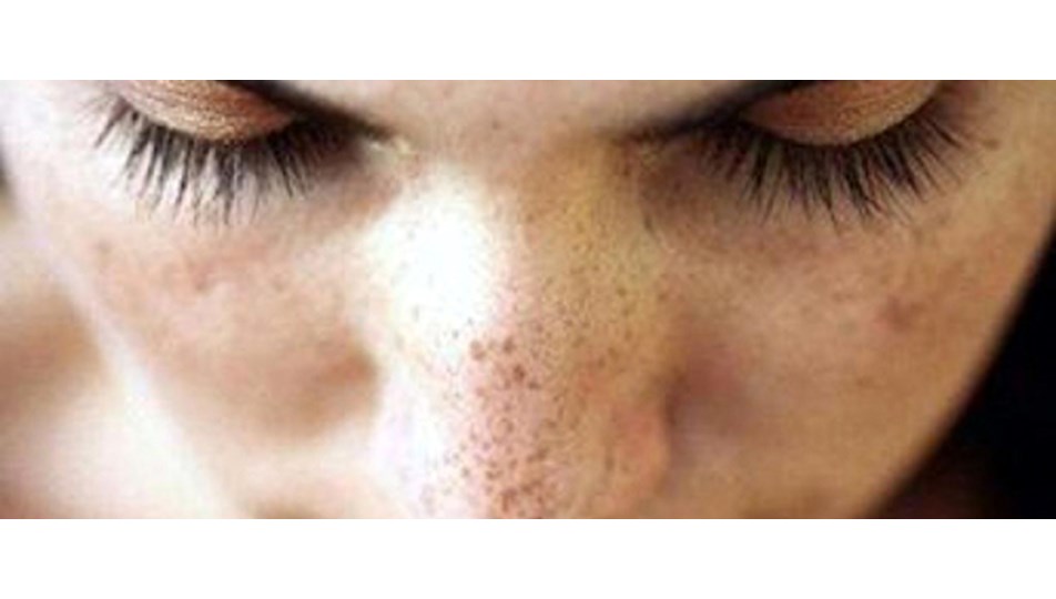 Güneş lekelerine PRP ve peeling ile veda edin